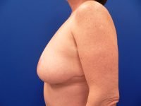 Left side profile results post-reduction mammoplasty, showcasing improved breast morphology and skin retraction.