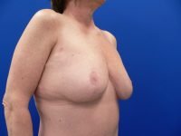 Right quarter-angle view post-surgery, demonstrating refined breast profile and resolved skin laxity after reduction.