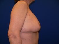 Right side profile after breast reduction, highlighting restored breast projection and defined infra-mammary fold.