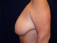 Left side profile view pre-surgery, showing breast morphology and skin elasticity prior to reduction mammoplasty.