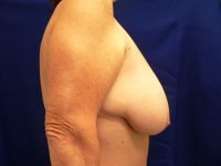 Right side profile of Emily before breast reduction, highlighting degree of sagging and infra-mammary fold position.