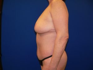 Left side profile post-surgery, showing final breast contour from reduction and a firm, contoured abdomen after abdominoplasty.