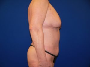 Right side profile results after mommy makeover, highlighting restored breast projection and a flat abdominal wall following tummy tuck.