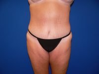 Frontal results after tummy tuck (abdominoplasty), showing tightened abdomen, repaired muscles, and smooth contour.
