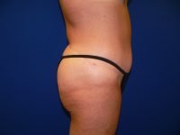 Right side profile after tummy tuck surgery, demonstrating improved abdominal flatness and resolved overhang.