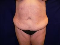Frontal view before tummy tuck (abdominoplasty), showing excess abdominal skin, laxity, and diastasis recti.