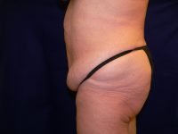 Left side profile view pre-abdominoplasty, demonstrating abdominal wall laxity and tissue redundancy.