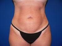 Liposuction After Front View