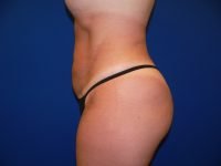 Liposuction After Left Side View