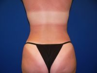 Liposuction After Waist View