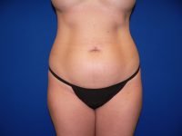 Liposuction Before Front View