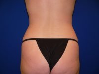 Liposuction Before Waist View