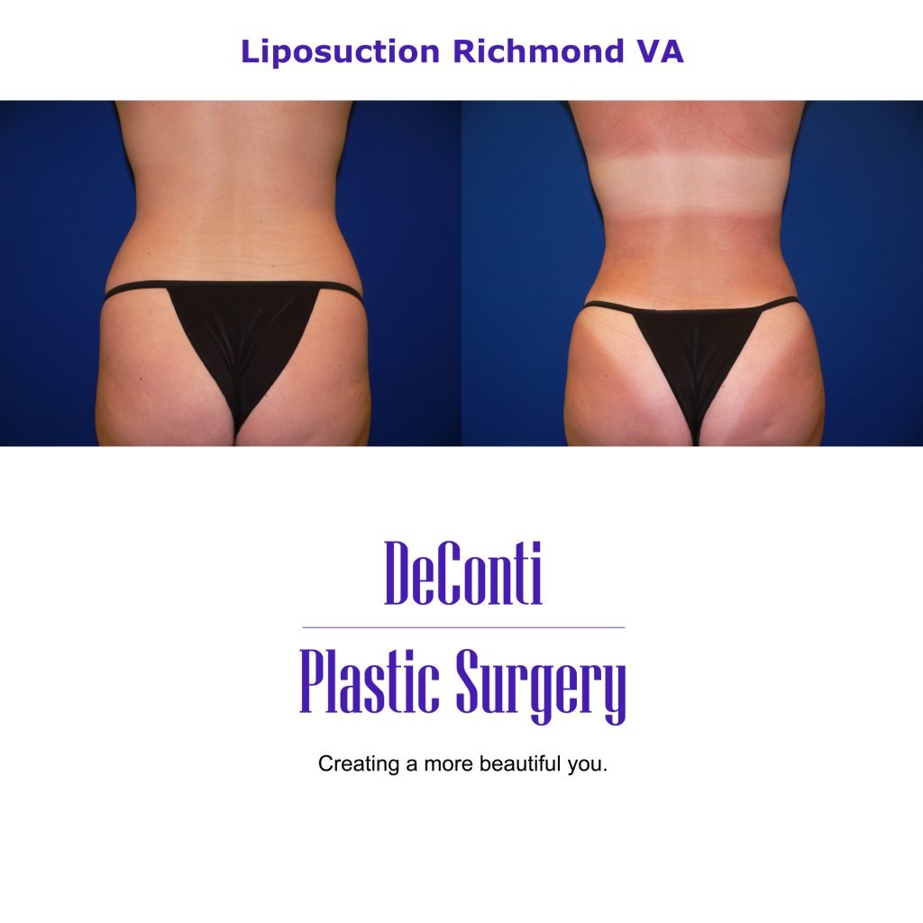 Liposuction Chesterfield VA Snatched Waist