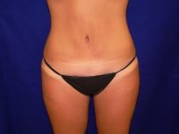 Tummy Tuck Scar