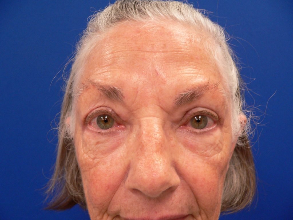 Blepharoplasty Ptosis Repair After Front View Photo