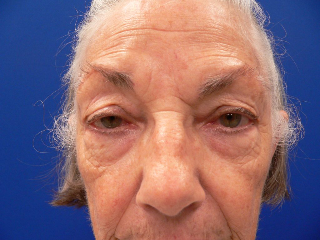 Blepharoplasty Ptosis Repair Before Front View Photo