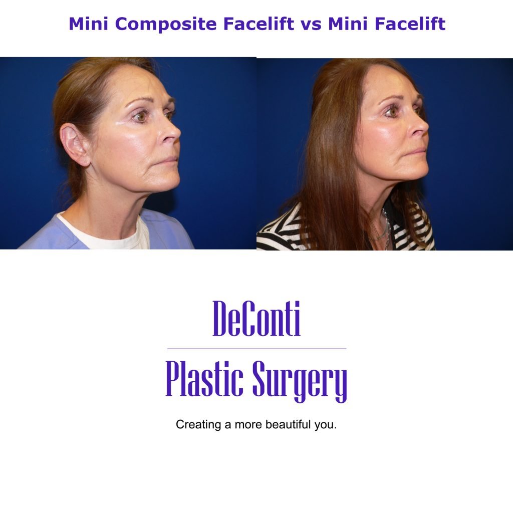 Mini Composite Facelift Near Me