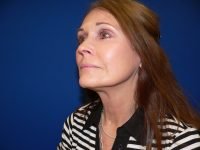 Mini Facelift After Left 45 Degree View Patient 152
