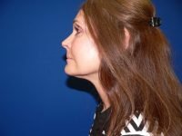 Mini Facelift After Left Profile View Patient 152