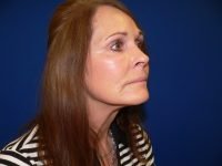 Mini Facelift After Right 45 Degree View Patient 152