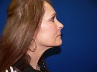 Mini Facelift After Right Profile View Patient 152