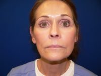 Mini Facelift Before Front View Patient 152