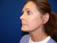 Mini Facelift Before Left 45 Degree View Patient 152