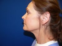 Mini Facelift Before Left Profile View Patient 152