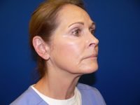 Mini Facelift Before Right 45 Degree View Patient 152
