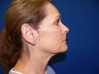 Mini Facelift Before Right Profile View Patient 152