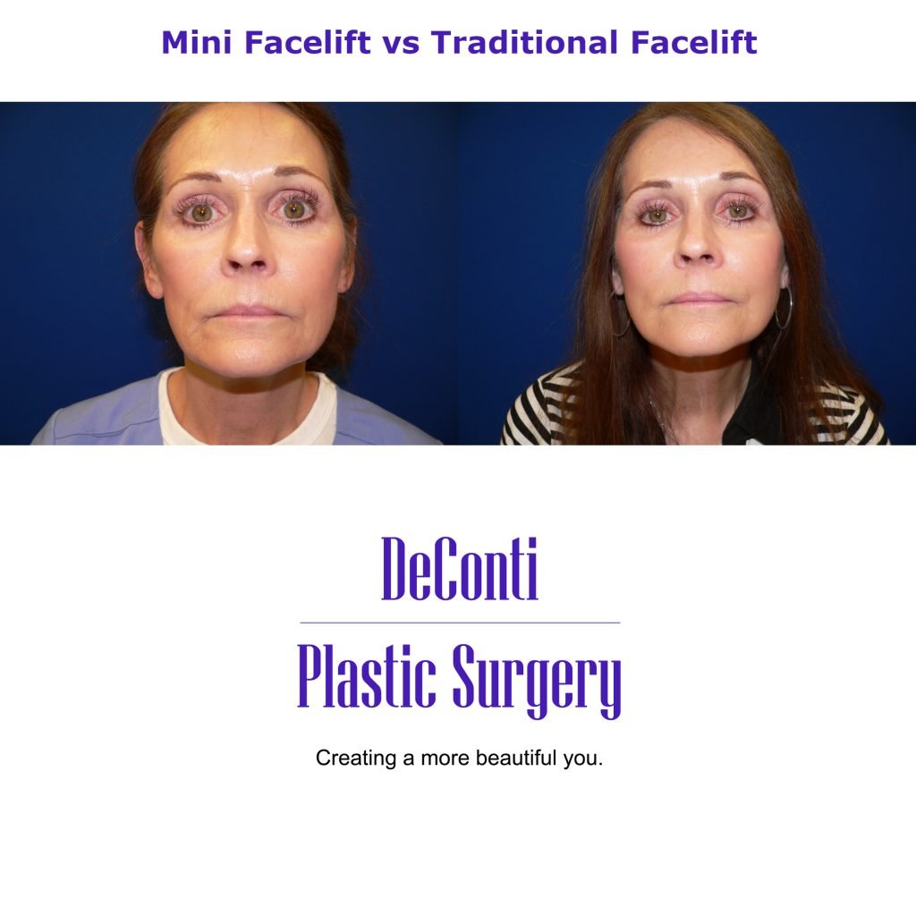 Mini Facelift Near Me